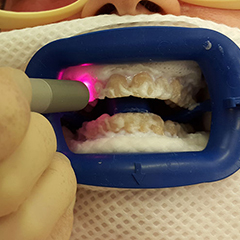 врач проводит отбеливание zoom 4 врач проводит отбеливание zoom 4